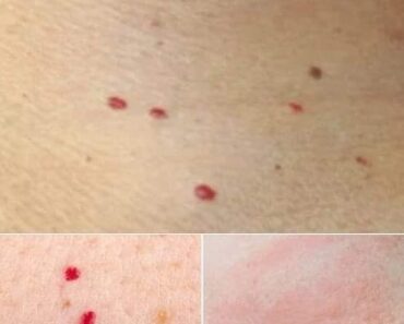 If you spot these red dots on your skin, here’s what they mean. Check the first comment ⤵️